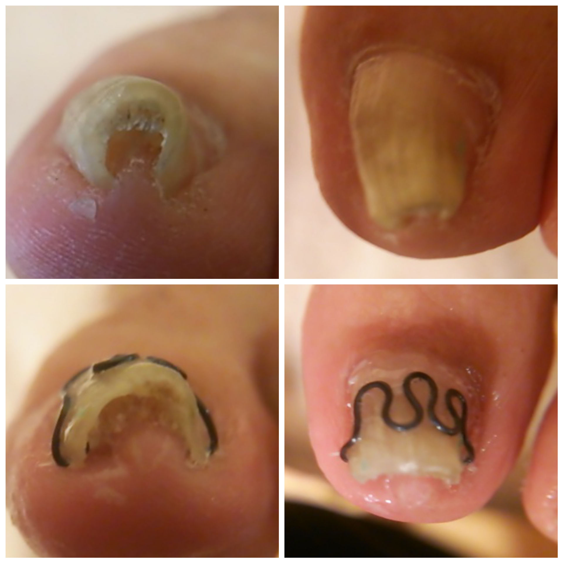 巻き爪　BSスパンゲ 矯正方法について | 東京で巻き爪なら巻き爪矯正専門院 東京巻き爪センター